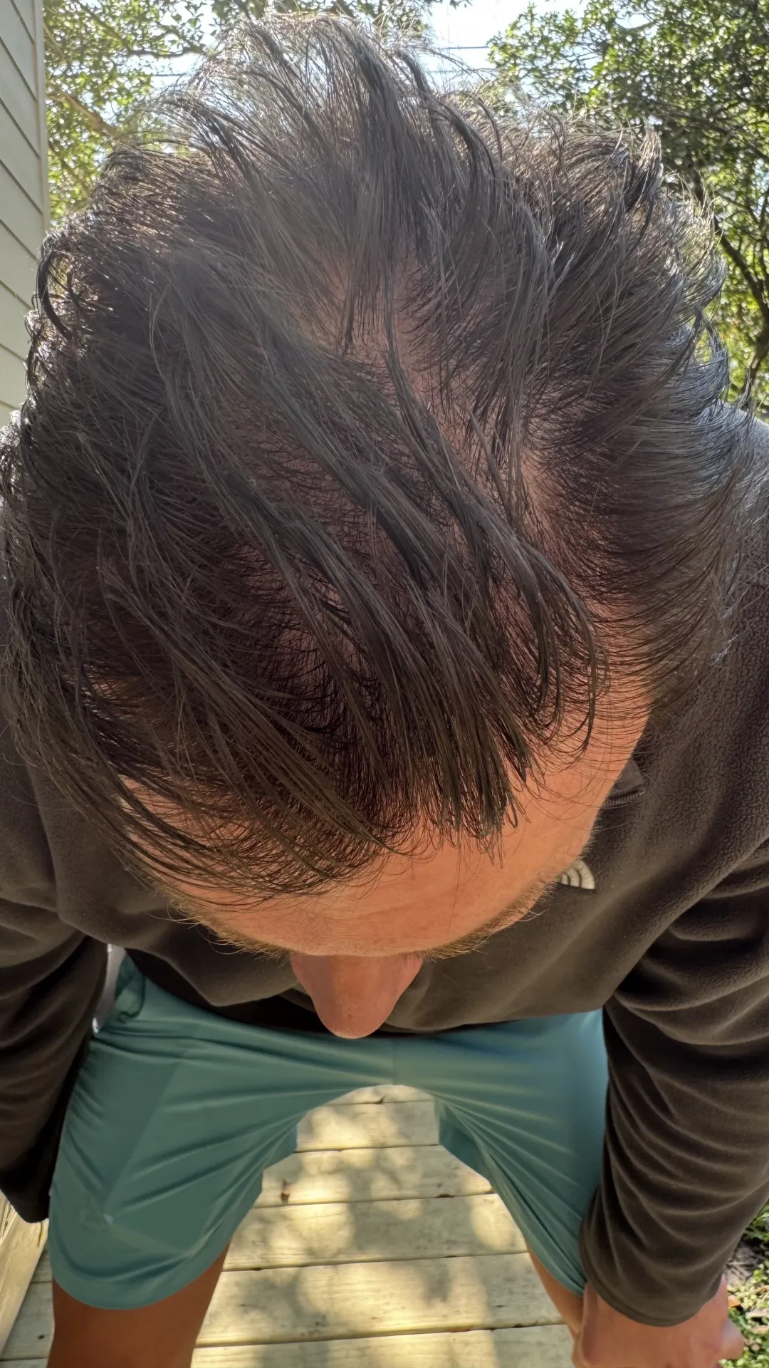 Ryan U. Hair Recovery